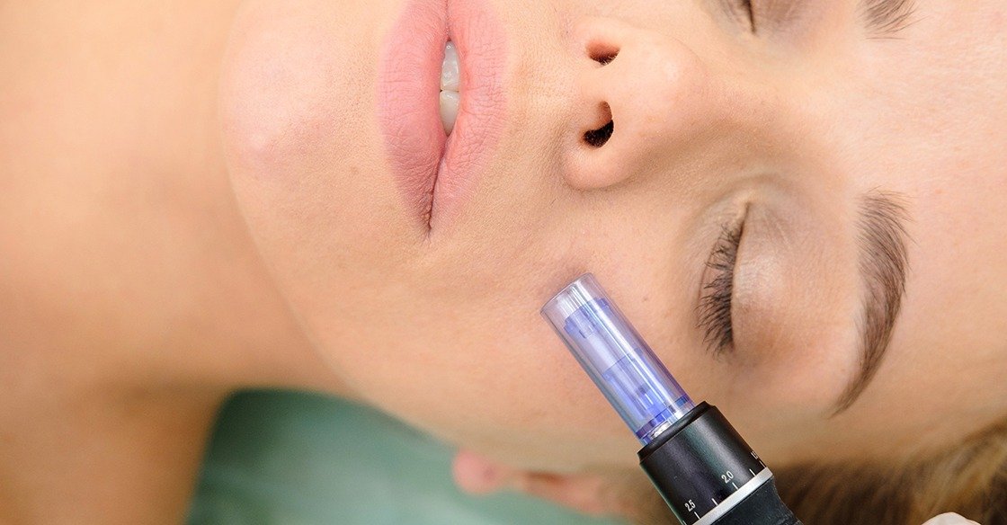 What To Expect During Your Microneedling Session