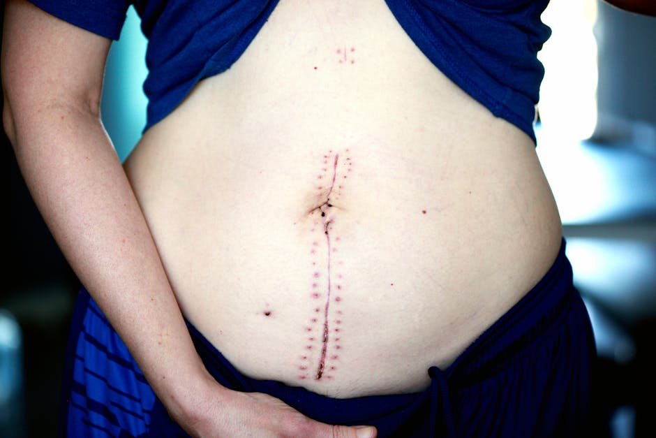 Understanding Scarring and Recovery After a Tummy Tuck