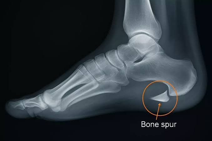 How Did I Get Heel Spurs?