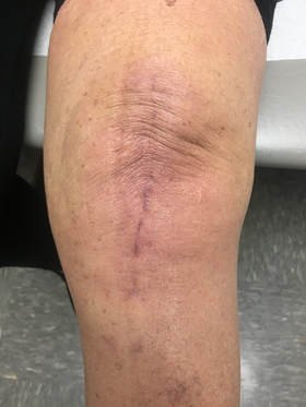 Long-Term Outcomes of Knee Replacement Surgery