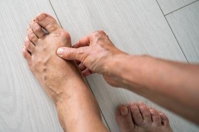 Recognizing the Signs of Bunions Early