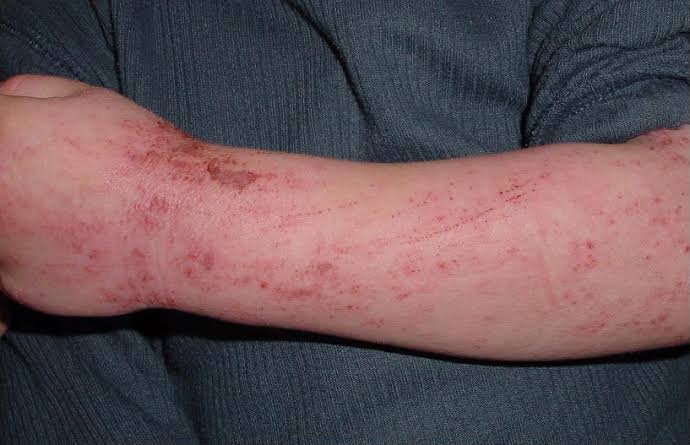 Signs That You Should Visit the Emergency Room for Allergic Reactions