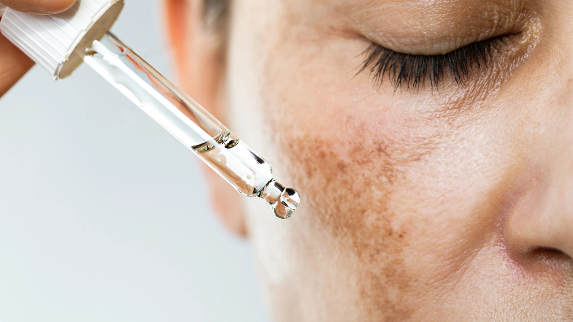 The Role of a Dermatologist in Managing Psoriasis