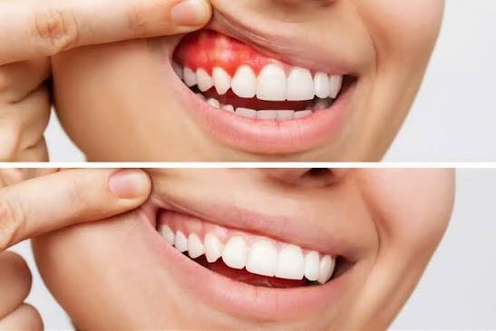 Tips for Preventing Gum Disease