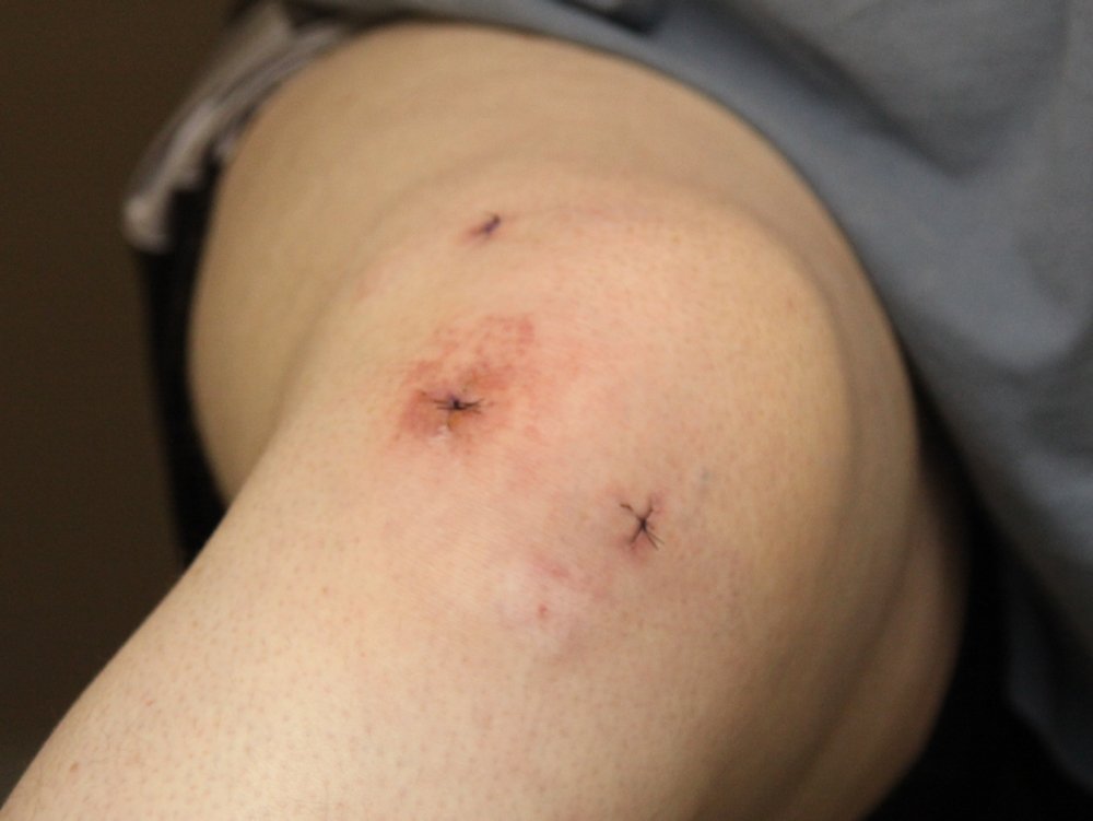 What To Expect Before, During, and After Knee Arthroscopy