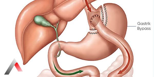 FAQs About Bariatric Surgery