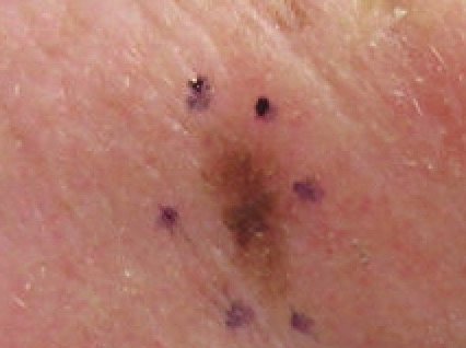 How To Recognize Early Signs of Skin Cancer