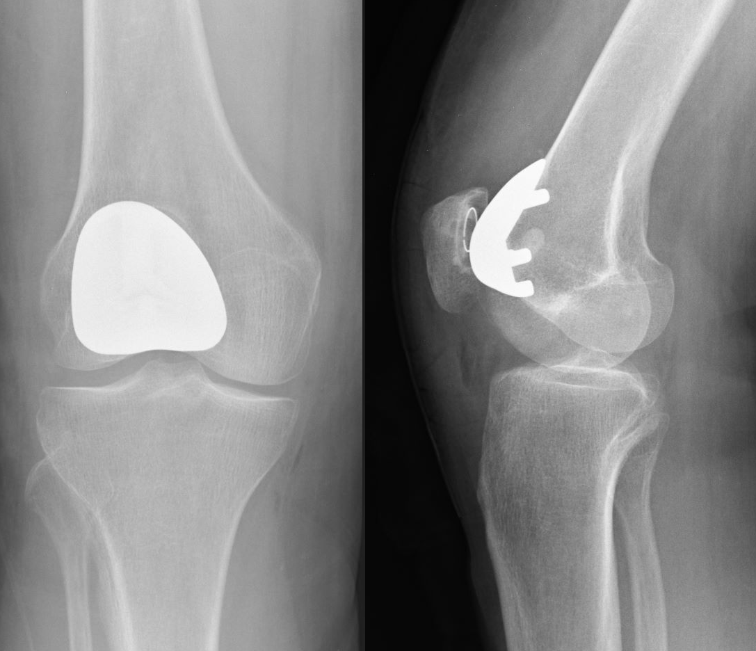 What to Expect Before and After Total Joint Replacement