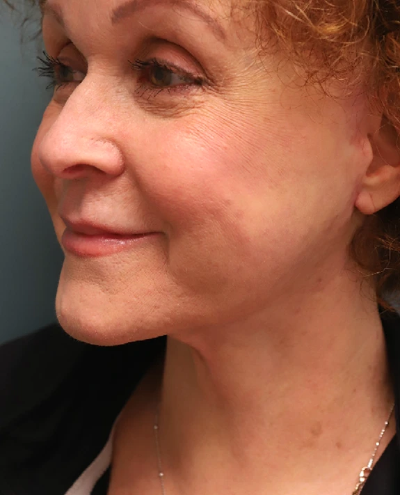 What to Know About Face Lift Surgery